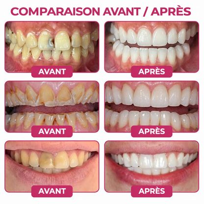 Glimmerly® 🍁💖DenPerm🎉— Gel Réparateur de l’Émail Naturel pour Caries, Dents Sensibles & Émail Fragilisé