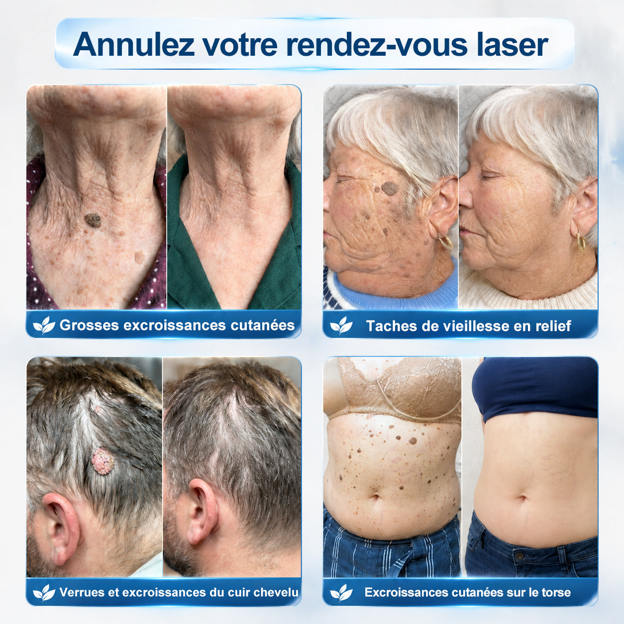 𝐏i𝐜𝐝o®🍁💖 7 𝑱𝒐𝒖𝒓𝒔 𝑬𝒇𝒇𝒂𝒄𝒆𝒖𝒓 𝒅𝒆 𝒕𝒂𝒄𝒉𝒆𝒔 𝒆𝒕 𝒅’𝒆𝒙𝒄𝒓𝒐𝒊𝒔𝒔𝒂𝒏𝒄𝒆𝒔 𝒄𝒖𝒕𝒂𝒏é𝒆𝒔(Roll-on zéro douleur, zéro cicatrice)