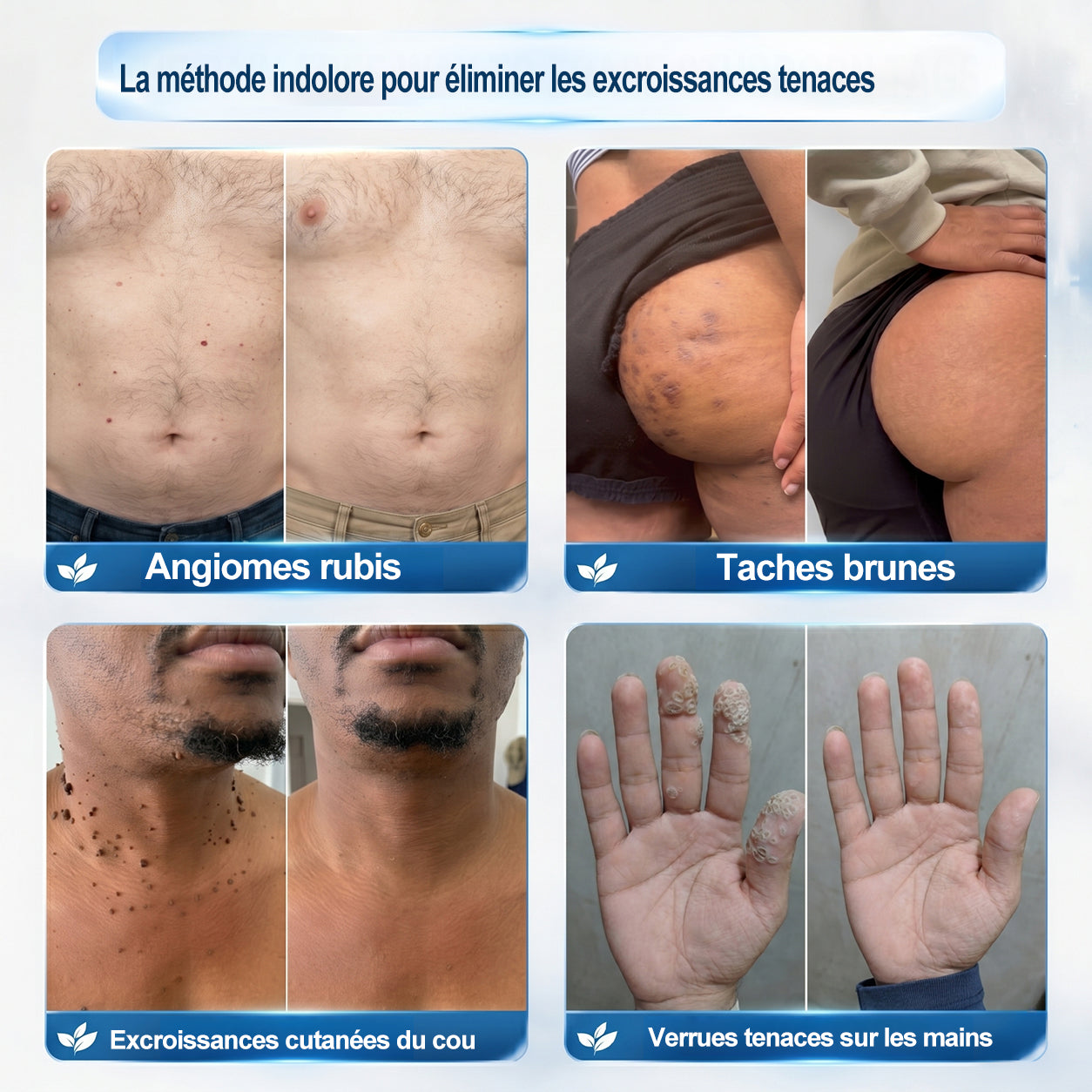 𝐏i𝐜𝐝o®🍁💖 7 𝑱𝒐𝒖𝒓𝒔 𝑬𝒇𝒇𝒂𝒄𝒆𝒖𝒓 𝒅𝒆 𝒕𝒂𝒄𝒉𝒆𝒔 𝒆𝒕 𝒅’𝒆𝒙𝒄𝒓𝒐𝒊𝒔𝒔𝒂𝒏𝒄𝒆𝒔 𝒄𝒖𝒕𝒂𝒏é𝒆𝒔(Roll-on zéro douleur, zéro cicatrice)