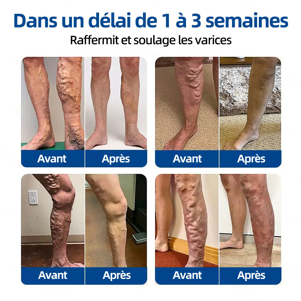 ✅𝐅𝐥𝐨𝐫𝐢𝐬𝐦𝐚®𝐂𝐢𝐛𝐥𝐞 𝐕𝐞𝐢𝐧𝐞𝐮𝐬𝐞 𝐏𝐚𝐭𝐜𝐡 À 𝐌𝐢𝐜𝐫𝐨-𝐀𝐢𝐠𝐮𝐢𝐥𝐥𝐞𝐬⚡Soulagement immédiat, résultats durables (UPSELL)